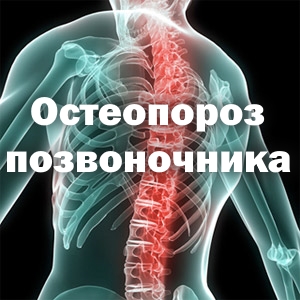 як лікувати остеопороз хребта