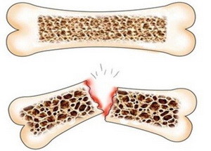 як лікувати остеопороз хребта
