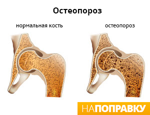 огляд остеопорозу