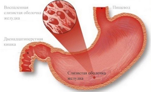 гострий гастрит запалення слизова шлунок жкт причини симптоми лікування