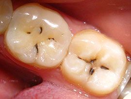 гострий карієс лікування зуб
