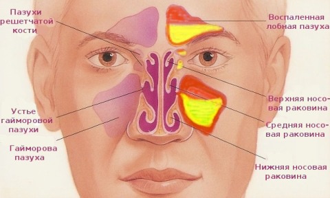 як лікувати синусит гайморит