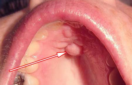 як лікувати папіломи у роті