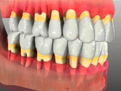 пародонтоз зубів