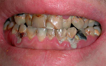 пародонтоз зубів