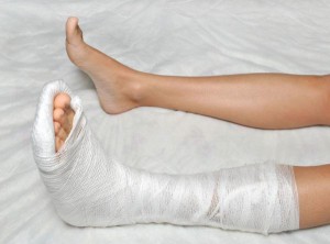як вилікувати ногу після перелому