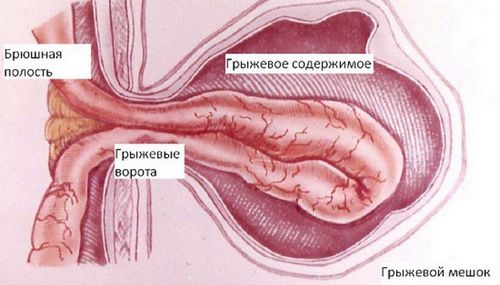 як лікувати жировик на животі