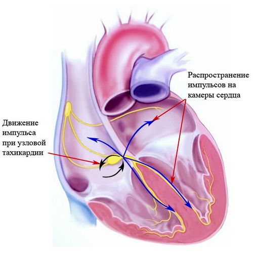 як лікувати тахікардію серця