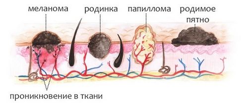 як вилікувати папіломи на шиї