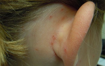 прищі за вухами причини появи лікування профілактика