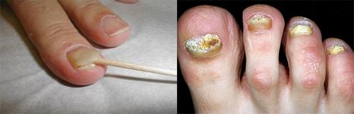 як лікувати псоріаз нігтів
