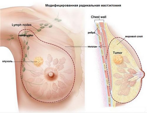 рак молочної залози лікування