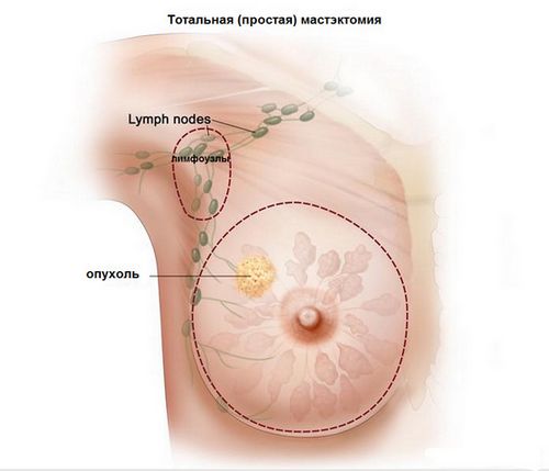 операція раку молочної залози