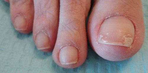лікувати листкові нігті
