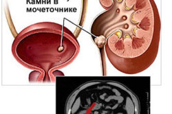 як лікувати мочесолевой діатез