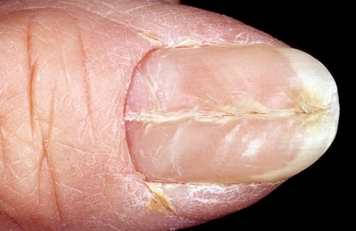 як лікувати дистрофію нігтів