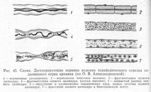 як лікувати розтягнення нерва