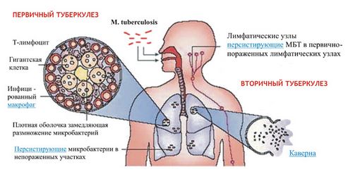 лікувати туберкульоз легенів