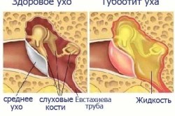 Тубоотит: симптоми і лікування отиту немає
