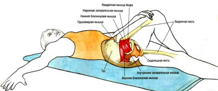 як лікувати невралгію сідничного нерва