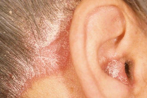 як лікувати дерматит у вухах