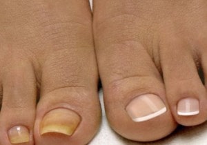 як лікувати товсті нігті на ногах