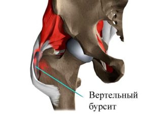 як лікувати бурсит тазостегнового суглоба