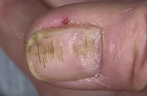 хвилясті нігті на руках: лікування та причини (з фото)