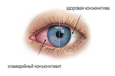 хламідійний кон'юнктивіт Офтальмохламідіоз збудник способи зараження класифікація симптоми діагностика лікування ускладнення очі патологія