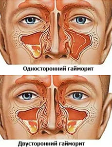 як лікувати хронічний синусит народними засобами