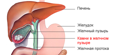 лікувати жовчокам'яна хвороба і холецистит