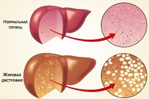 як лікувати жировій інфільтрації печінки