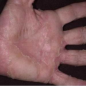 екзема алергічна алергія руки ноги лікування причини