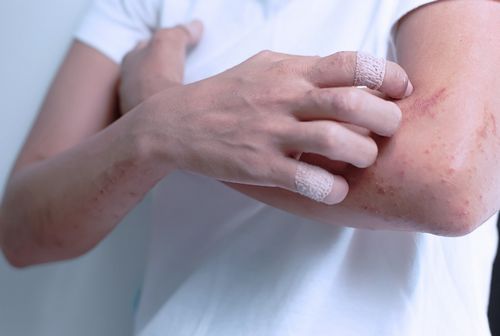 екзема алергічна алергія руки ноги лікування причини