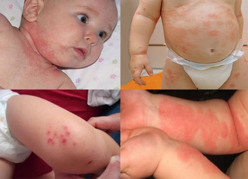 як лікувати алергічний дерматит у дитини