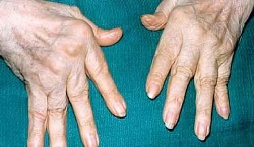 як лікувати артрит суглобів кисті рук