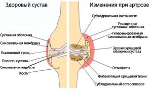 чи можна вилікувати артроз 3 ступеня