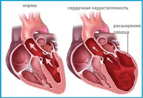 як лікувати астму серця
