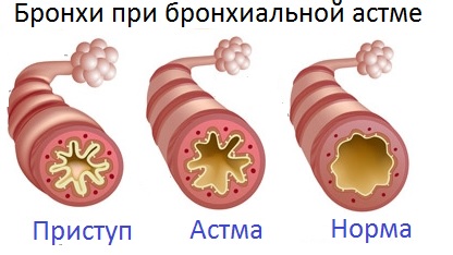 бронхіальна астма