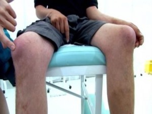 бурсит колінного суглоба лікування