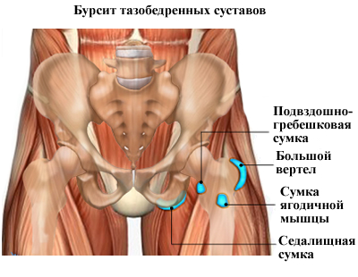 бурсит стегно суглоб симптом лікування біль синовіальний сумка бурса