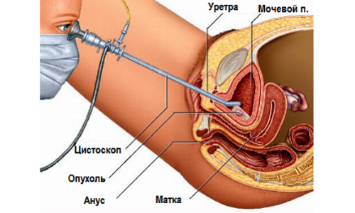 як лікувати сечовий міхур під час вагітності