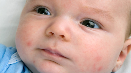 діатез немовля лікування симптоми виглядає причини мазь