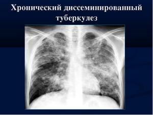 дисемінований туберкульоз легенів заразний заразитися