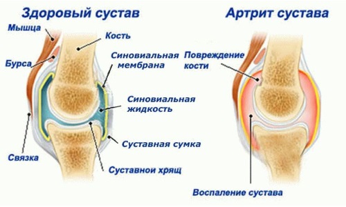 як лікувати артрит артроз народними засобами