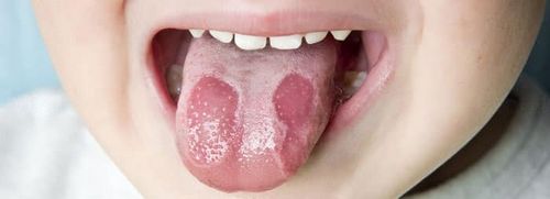 як лікувати стоматит в роті народними засобами