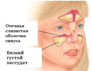 хронічний ексудативний гайморит