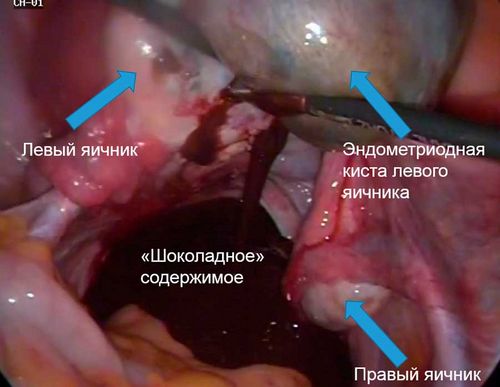 як вилікувати ендометріоїдних кісти