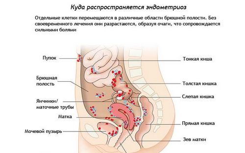 чи можна вилікувати ендометріоз без гормонів