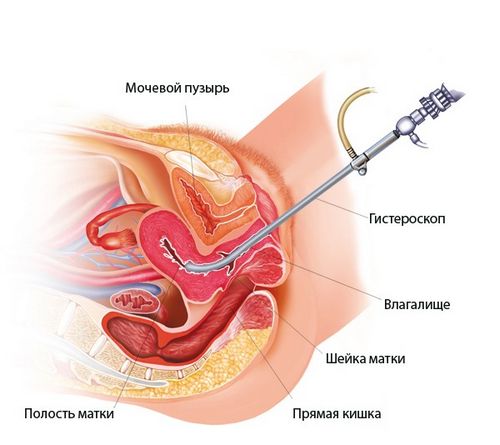 як лікувати хворобу ендометрит